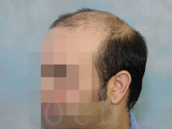 Scalp Micropigmentation: Case 4 - Before