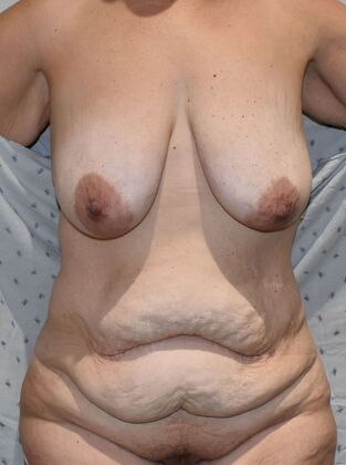 Massive Weight Loss : Case 122 - Before