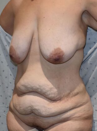 Massive Weight Loss : Case 122 - Before