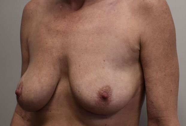 Breast Augmentation w/ Lift: Case 465 - Before