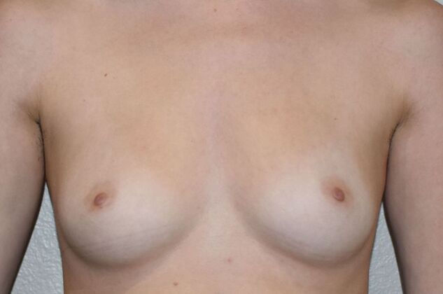 Breast Augmentation Case 722 - Before