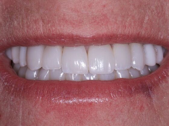 Smile Makeover: Lori - After