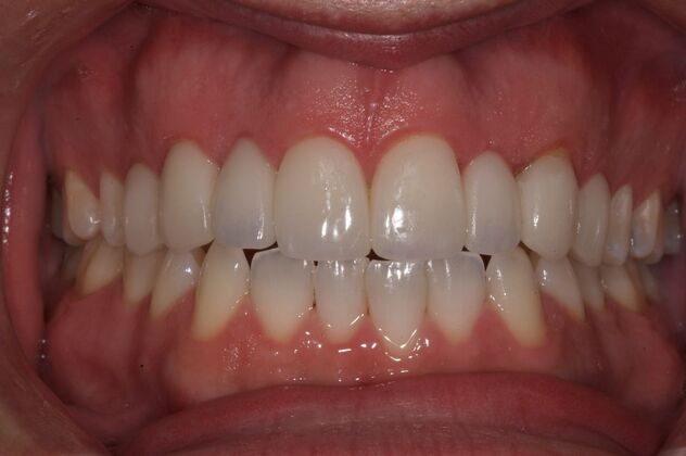 Smile Makeover: Xavier - After