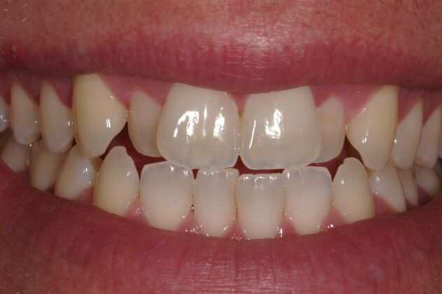 Smile Makeover: Xavier - Before