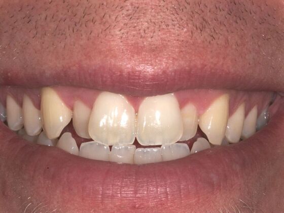 Smile Makeover Xavier - Before