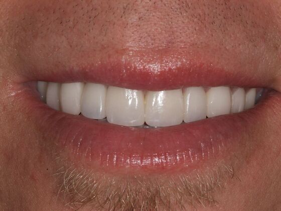 Smile Makeover Xavier - After