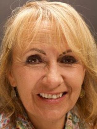 Veneers Lisa - Before