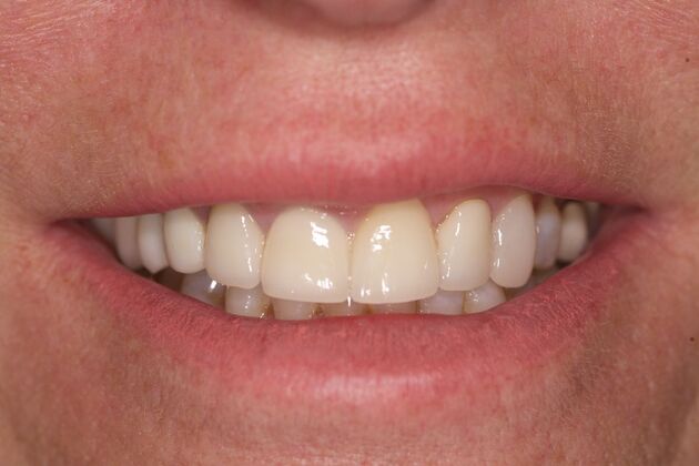 Full Mouth Rehabilitation : Sue - Before