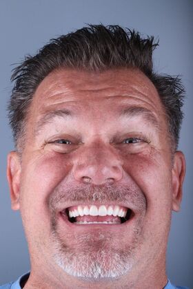 Crowns Todd Schufelt - After