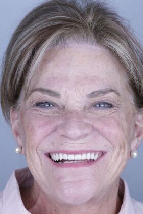 All-on-4 / All-on-6 Candance Steill  - Before