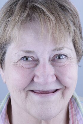 All-on-4 / All-on-6 Vera Poley - Before
