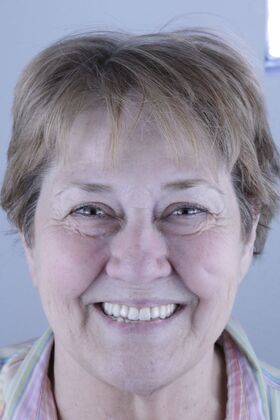 All-on-4 / All-on-6 Vera Poley - After
