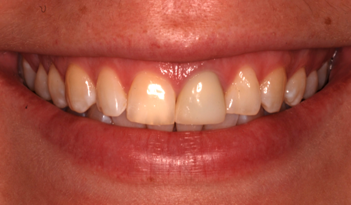 Porcelain Crowns: Sherri B. - Before