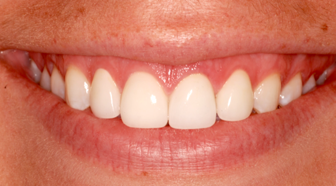 Porcelain Crowns: Sherri B. - After