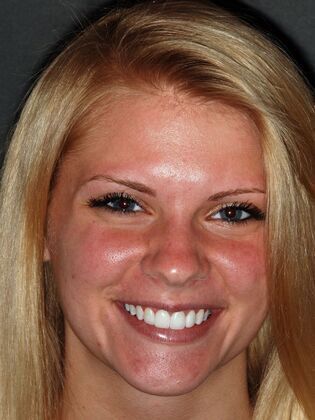 Laser Dentistry - Gummy Smile Amber C. - After