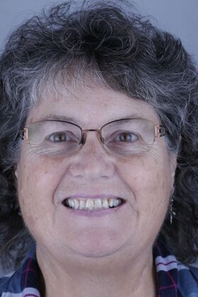 Ceramic Veneers : Case 4 - Before