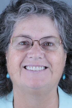 Ceramic Veneers : Case 4 - After