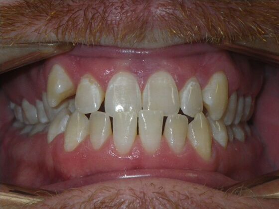 Invisalign: Case 13 - Before