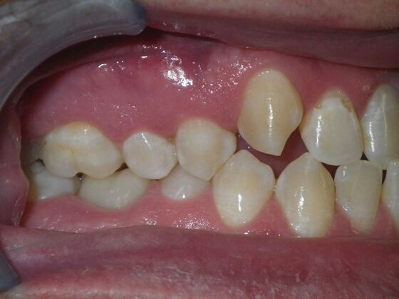 Invisalign: Case 13 - Before