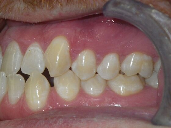 Invisalign: Case 13 - Before