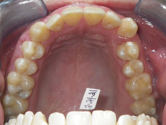 Invisalign: Case 13 - Before
