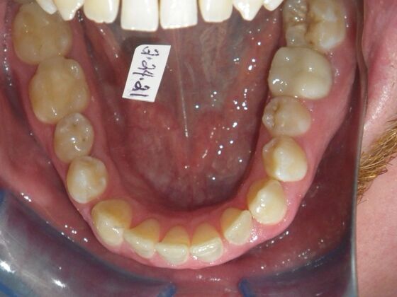 Invisalign: Case 13 - After