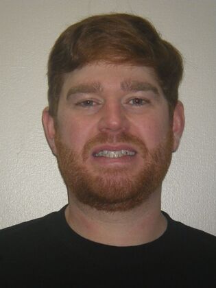 Invisalign: Case 13 - Before