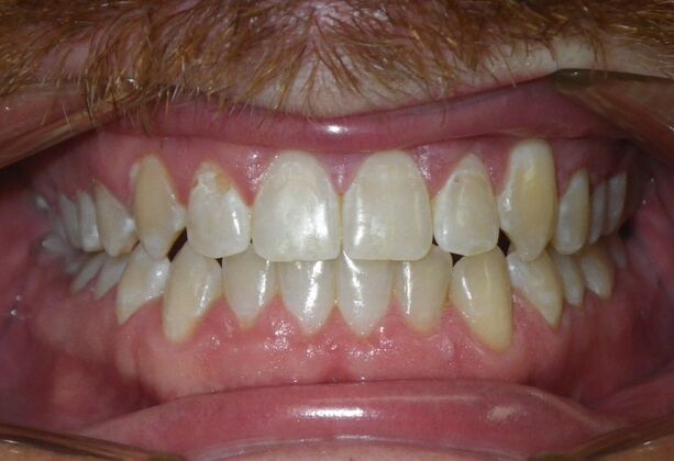 Invisalign: Case 13 - After