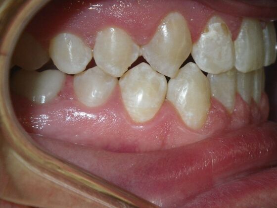 Invisalign: Case 13 - After