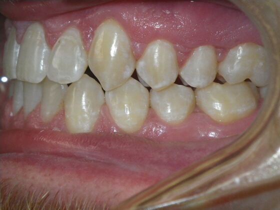 Invisalign: Case 13 - After