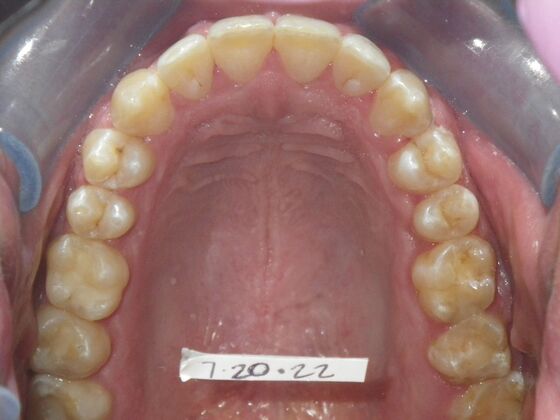 Invisalign: Case 13 - After