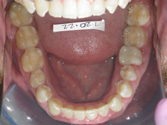 Invisalign: Case 13 - Before