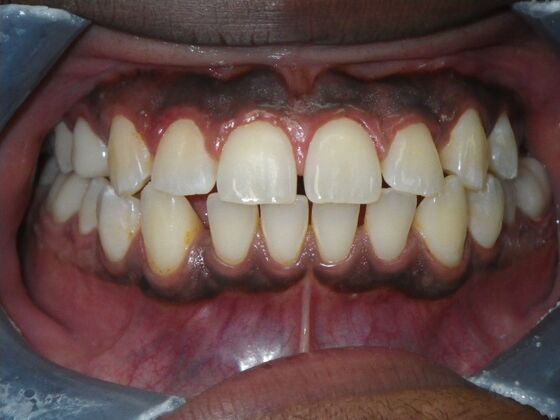 Invisalign: Case 14 - Before