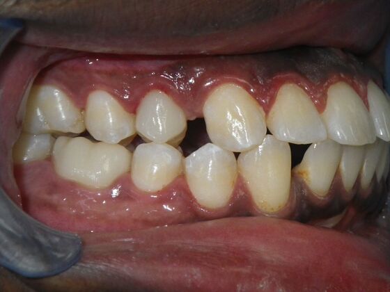 Invisalign: Case 14 - Before