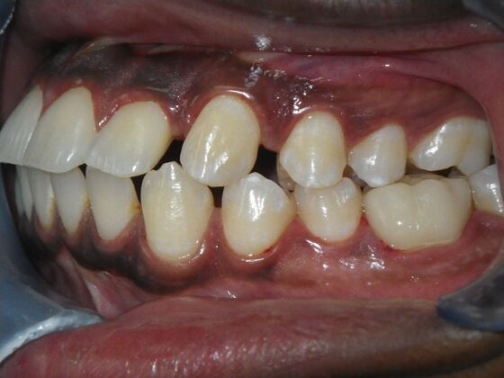 Invisalign: Case 14 - Before