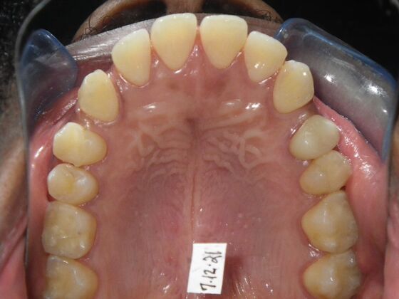 Invisalign: Case 14 - Before