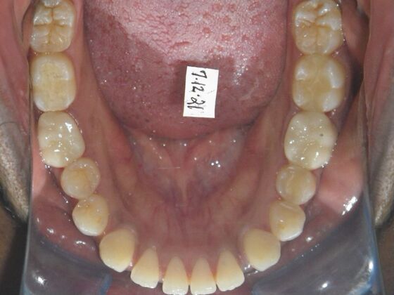 Invisalign: Case 14 - Before