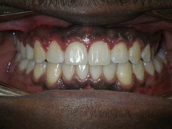 Invisalign: Case 14 - After