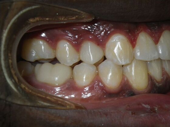 Invisalign: Case 14 - After