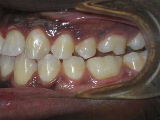 Invisalign: Case 14 - After