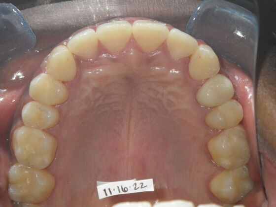 Invisalign: Case 14 - After
