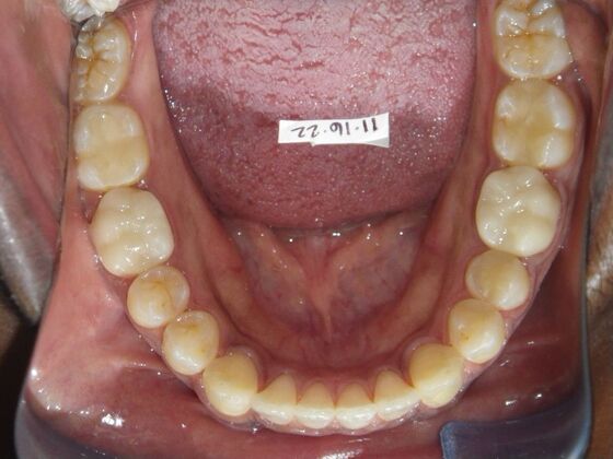 Invisalign: Case 14 - After