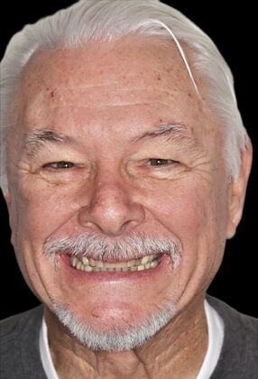 Full Mouth Restoration Jacob - Before