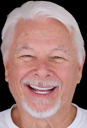 Full Mouth Restoration Jacob - After