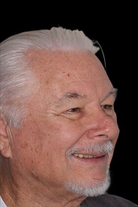 Full Mouth Restoration: Jacob - Before