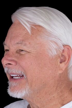 Full Mouth Restoration: Jacob - After