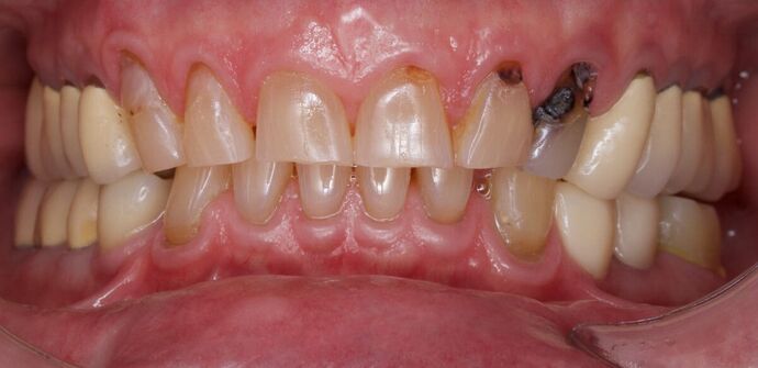 Full Mouth Restoration: Jacob - Before