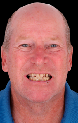 Full Mouth Restoration Dave S - Before