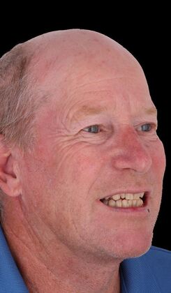 Full Mouth Restoration: Dave S - Before