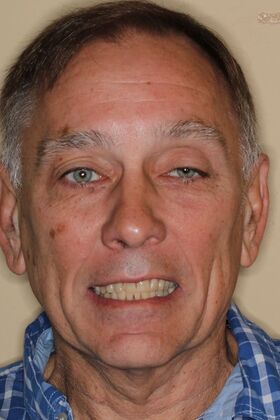 Veneers Case 31 - Before